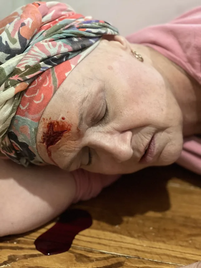 Blunt force trauma- Wound