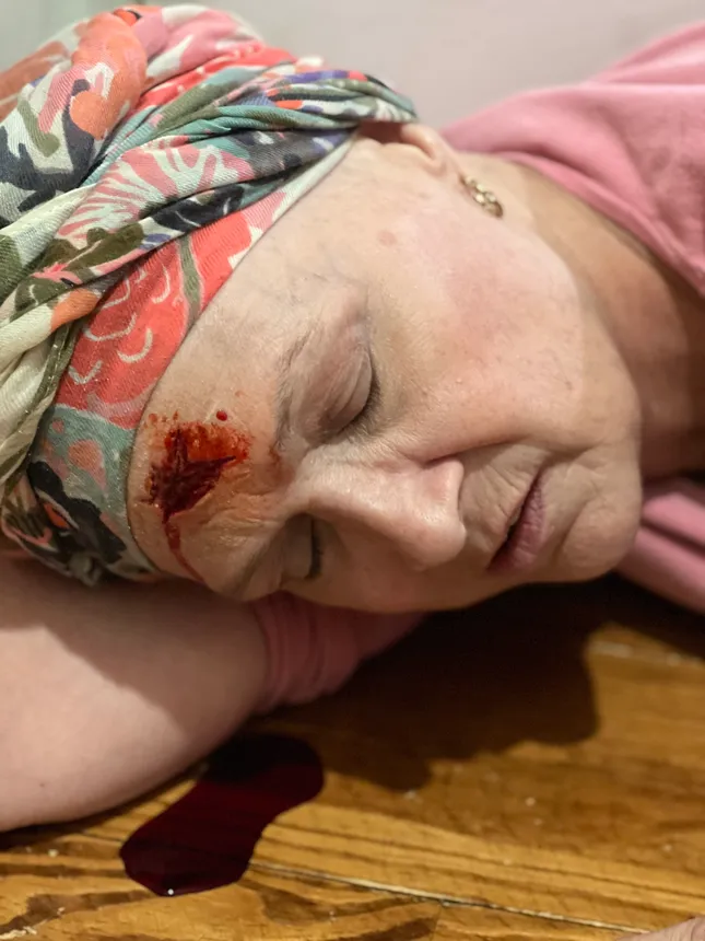 Blunt force trauma- Wound