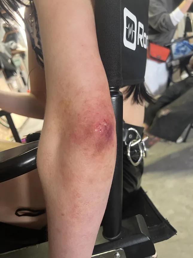 Bruises for Documentary