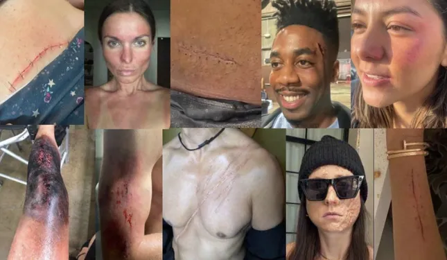 Scars
