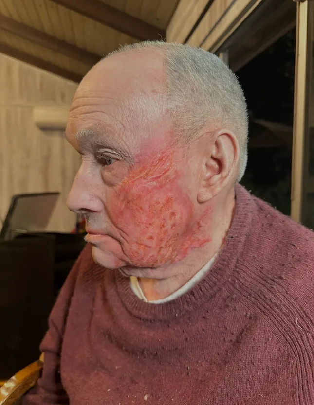 Burn Injury