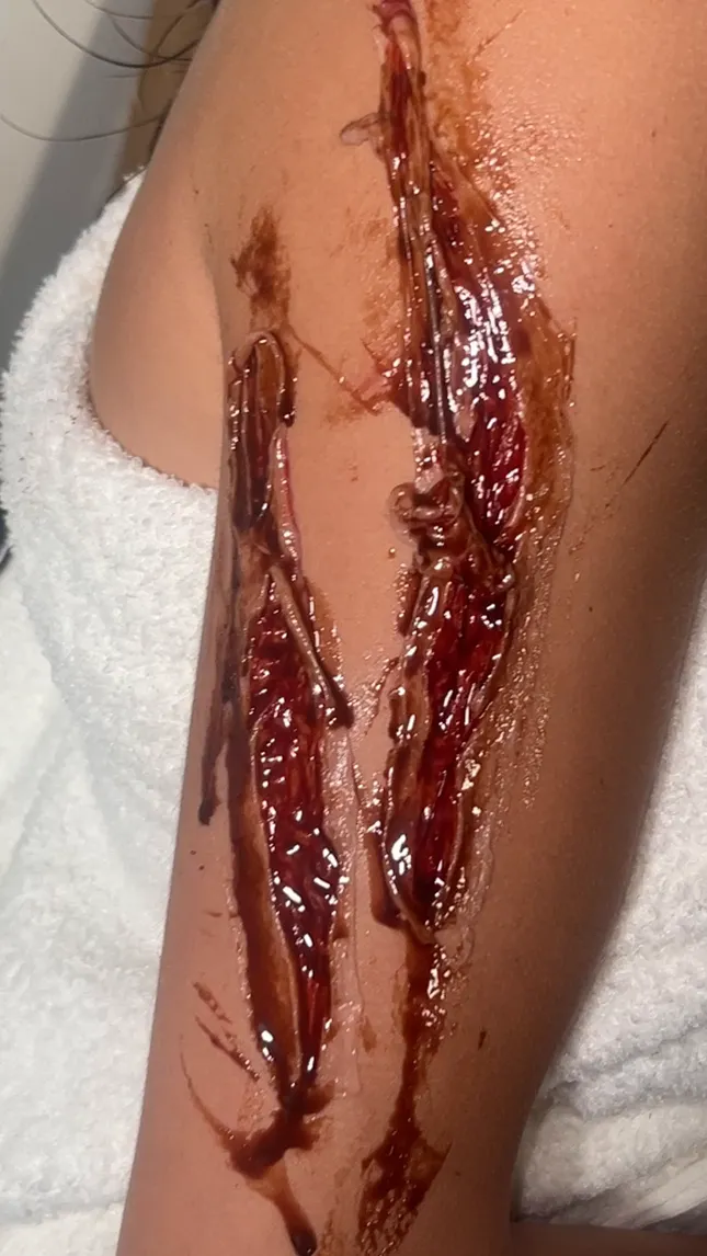 Halloween scar and blood work