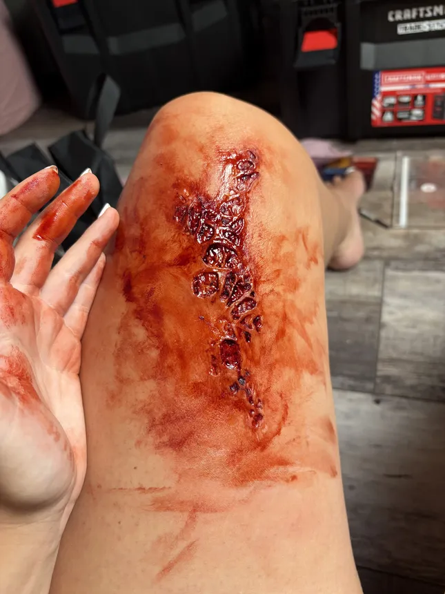 Trauma