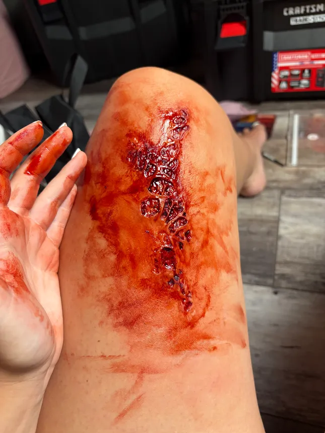 Trauma