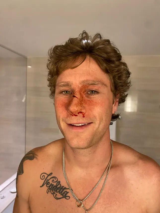 Broken Nose
