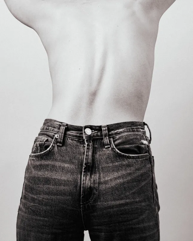 scoliosis