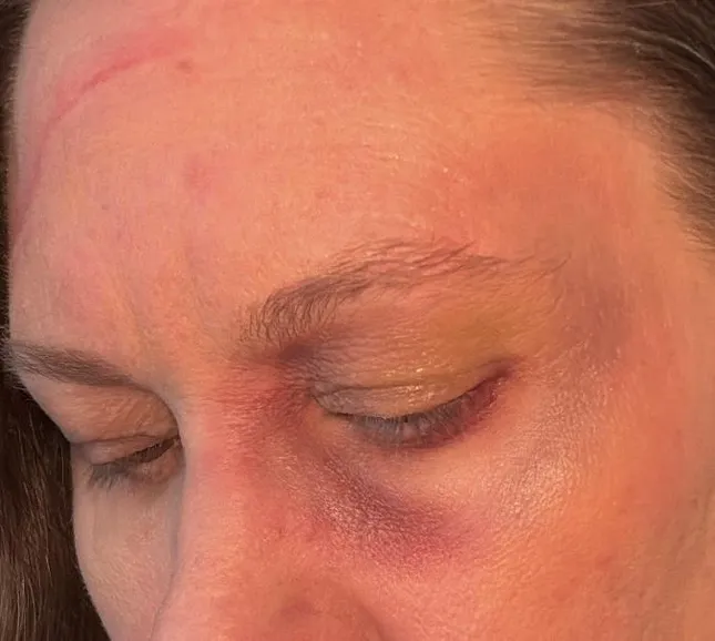 Bruising