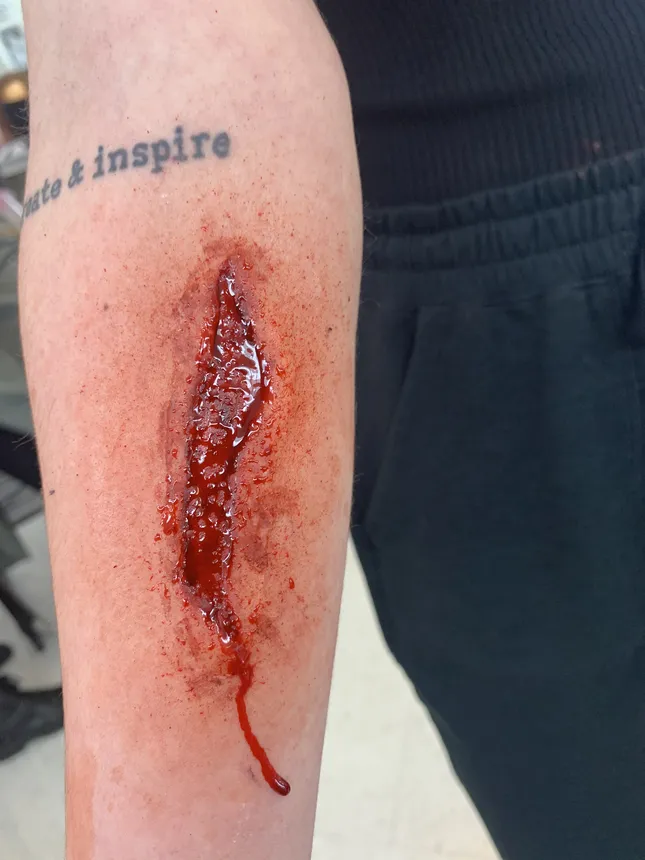 Injuries