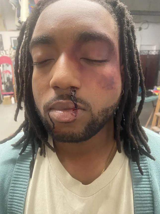 Bruising