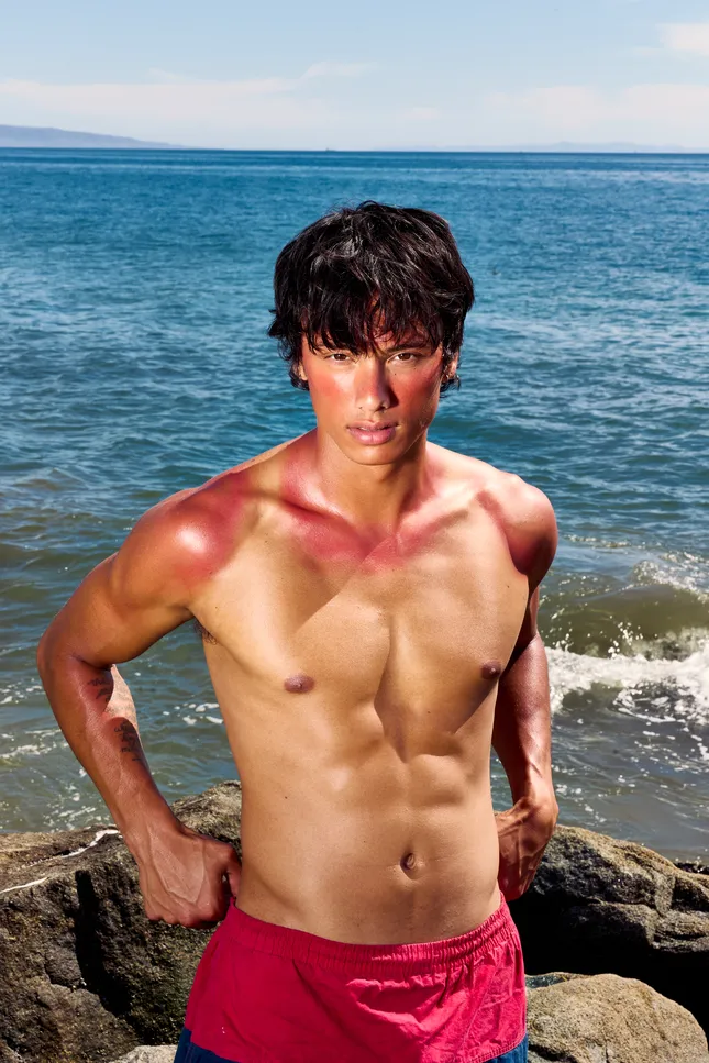 Summer Sunburn Editorial
