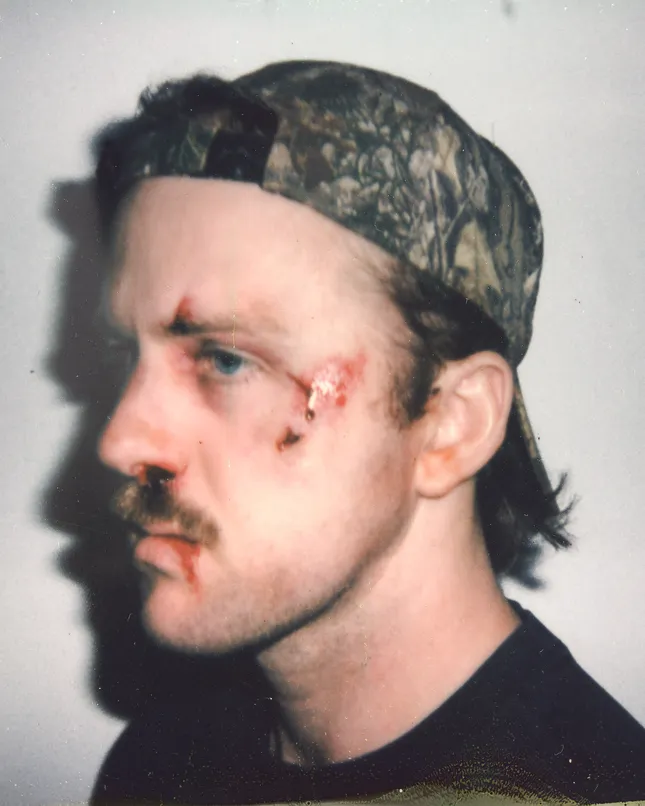 Black eye/Bruising