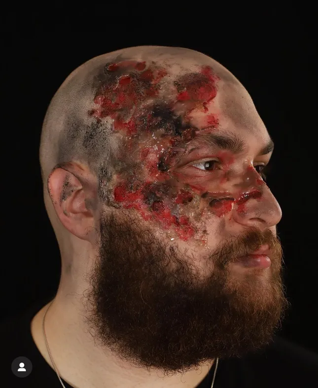 3rd Degree Burn SFX