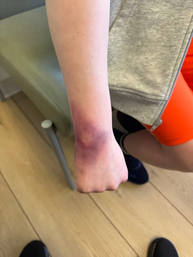 Broken Wrist Bruise